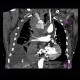 Cardiac tamponade, mediastinal hematoma, dissection of truncus brachiocephalicus: CT - Computed tomography